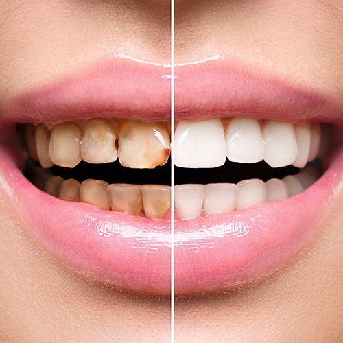 Эстетическое восстановление зубов на фото