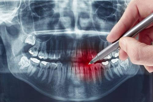 Киста корня зуба лечение лазером thumbnail