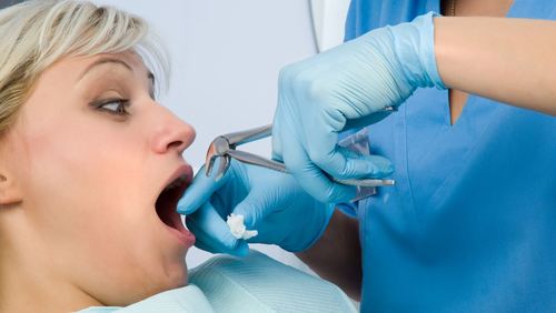 Удаление клещами стоматологическими