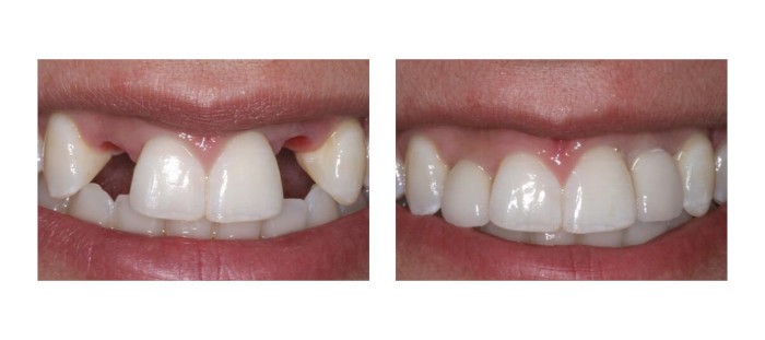 Как скрыть отсутствие переднего зуба Лечение зубов под наркозом Томск Сенная Курья
