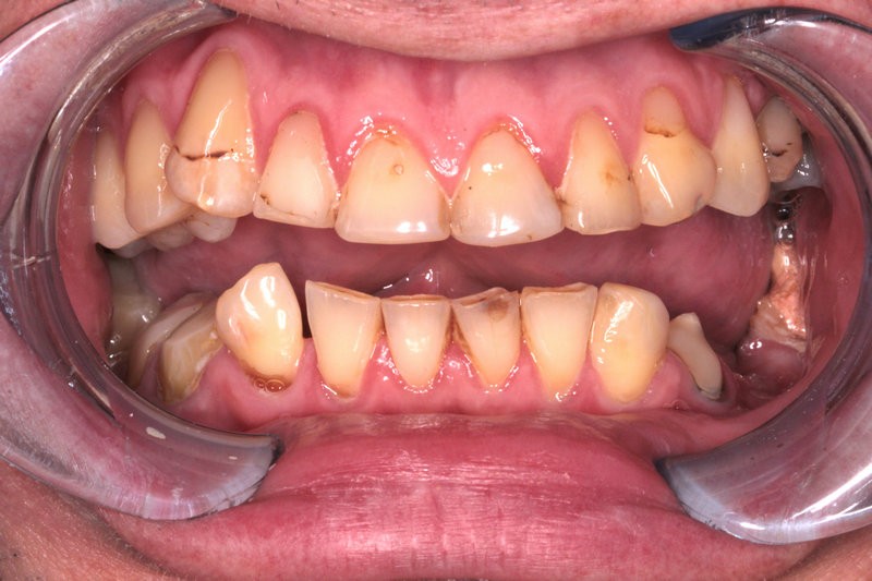 Классическая (двухэтапная) имплантация зубов с отсроченной нагрузкой - фото до лечения