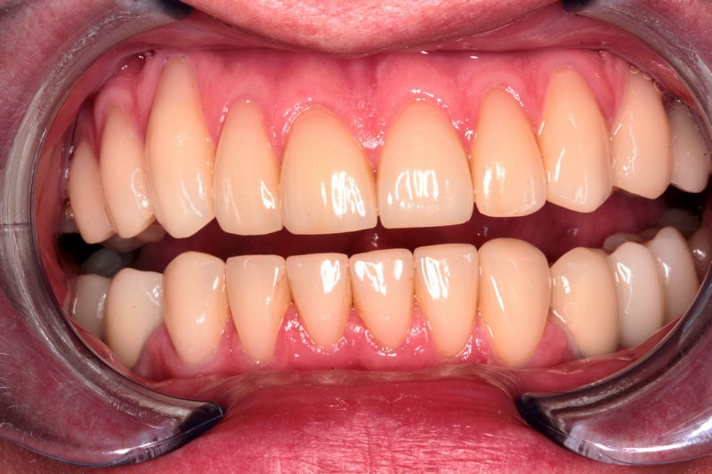 Классическая (двухэтапная) имплантация зубов с отсроченной нагрузкой - фото после лечения