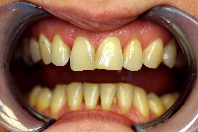 Керамические виниры E-max на зубы - фото до лечения