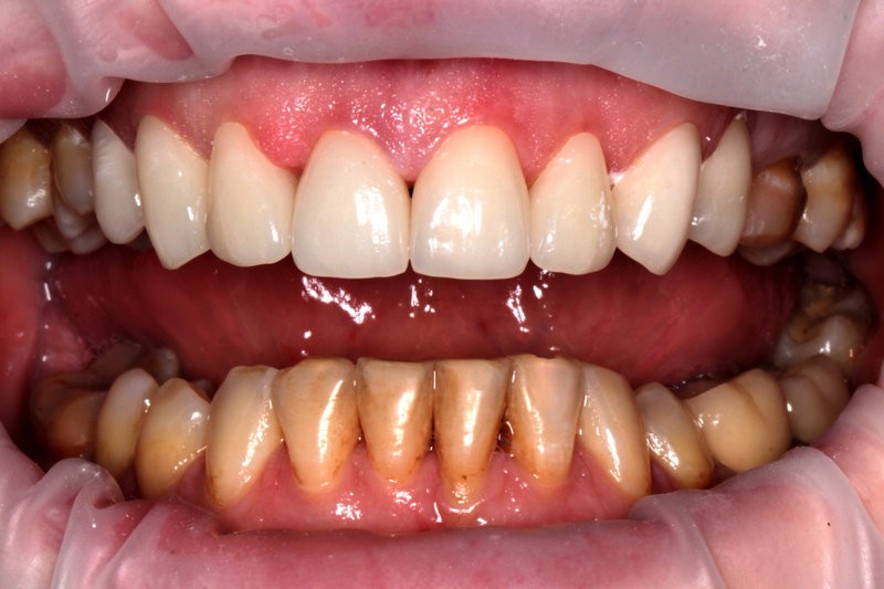 Керамические виниры E-max на зубы - фото после лечения