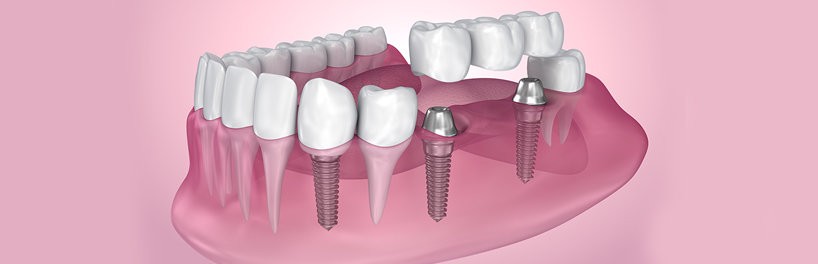Приживление импланта зуба