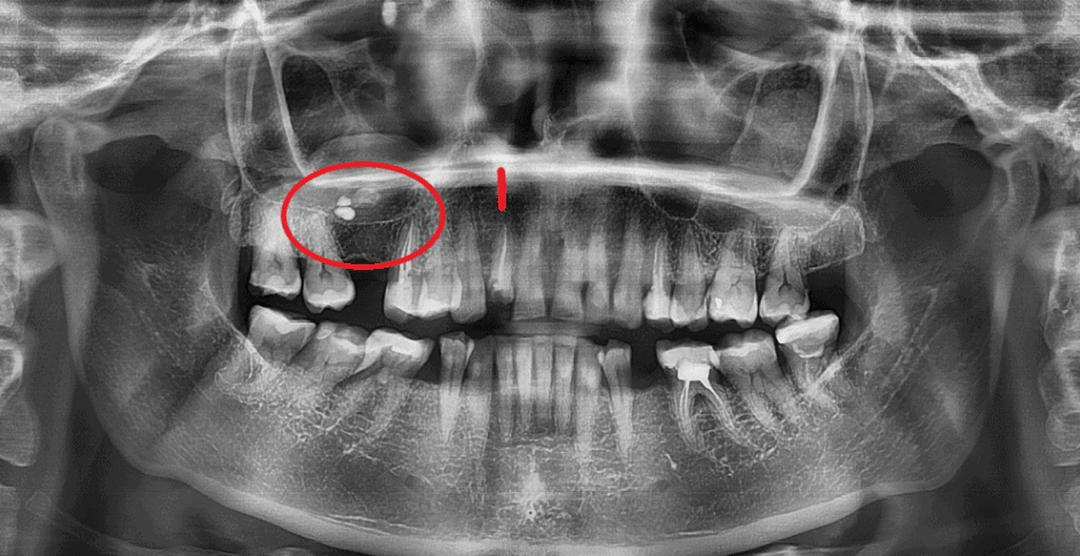 ретинированный зуб в гайморовой пазухе