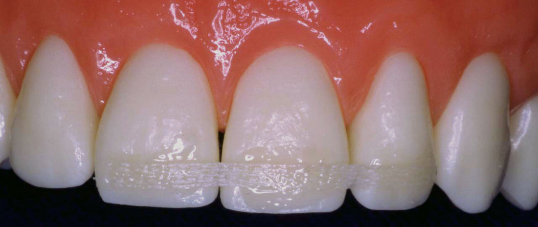 Зачем необходимо шинирование зубов при заболеваниях десен