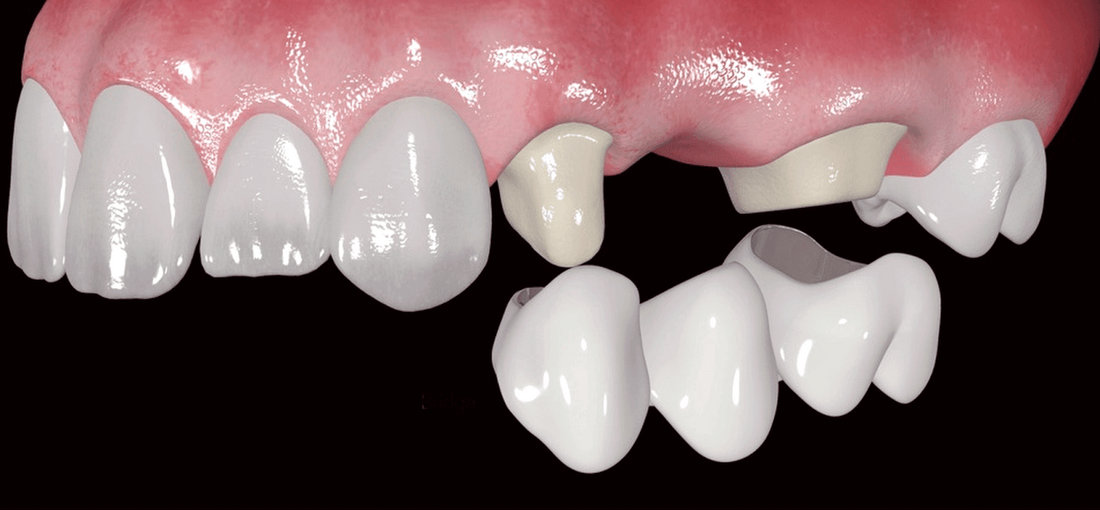 Что такое зубной мост, когда ставят на зубы
