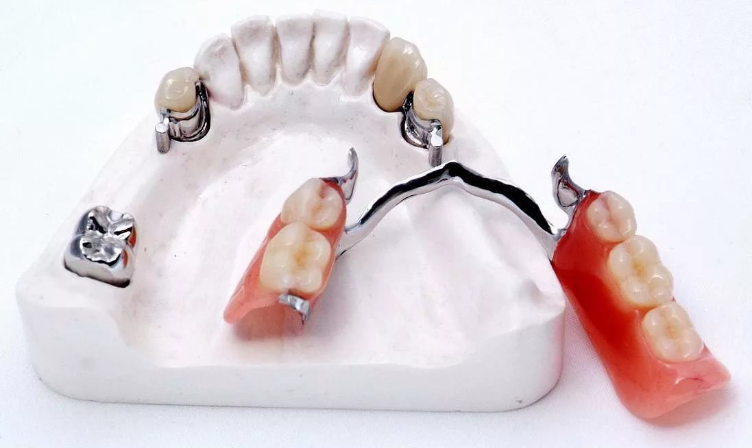 Как выглядят нижние бюгельные протезы для зубов