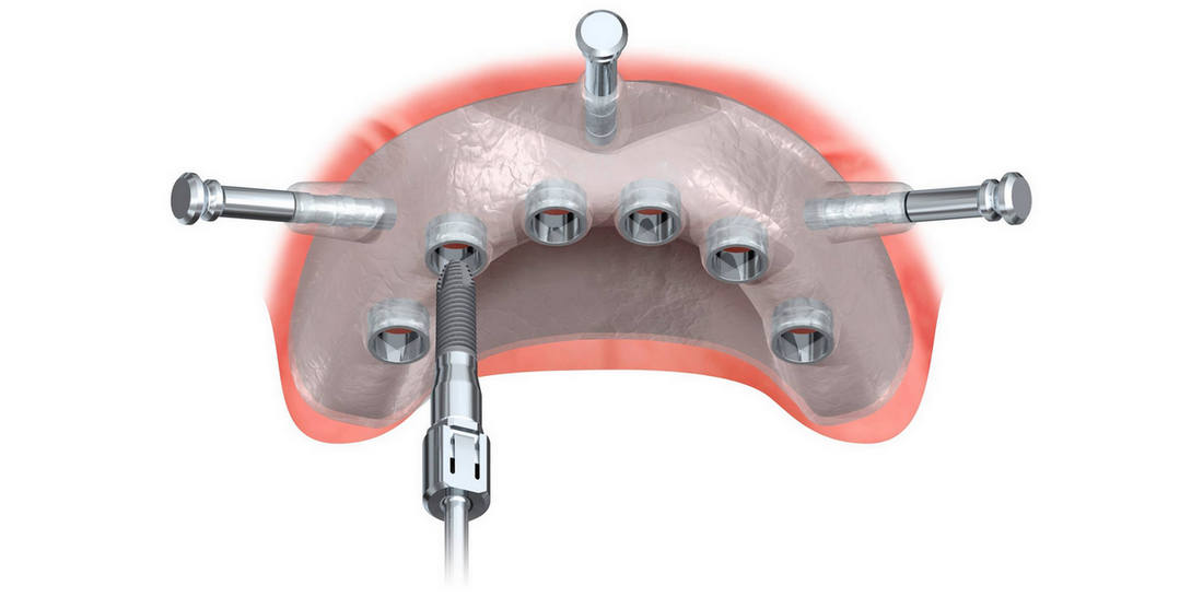 Что такое хирургический 3D-шаблон для имплантации