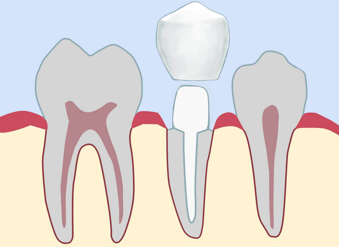 Культевая вкладка под коронку для укрепления зуба